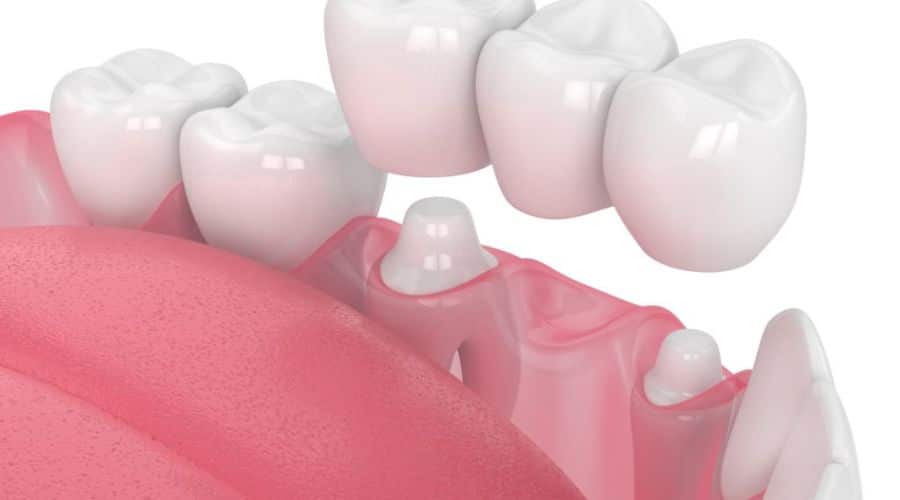 Dental Crowns Fall Out?