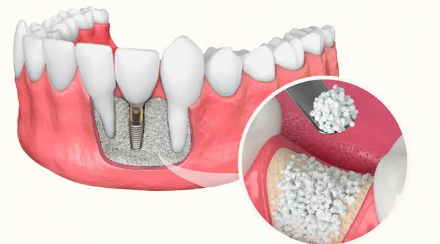 How long does the pain last after a dental bone graft?
